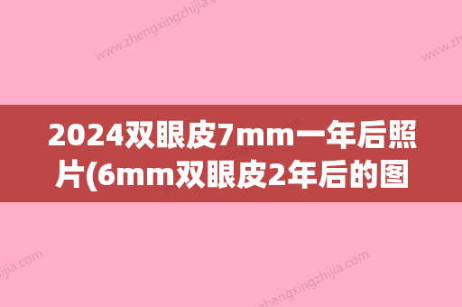 2024双眼皮7mm一年后照片(6mm双眼皮2年后的图片)