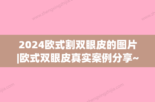 2024欧式割双眼皮的图片|欧式双眼皮真实案例分享~(欧式双眼皮什么样子)