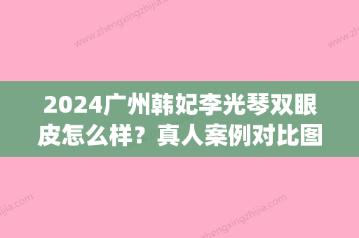 2024广州韩妃李光琴双眼皮怎么样？真人案例对比图片一览(广州韩妃美容整形)