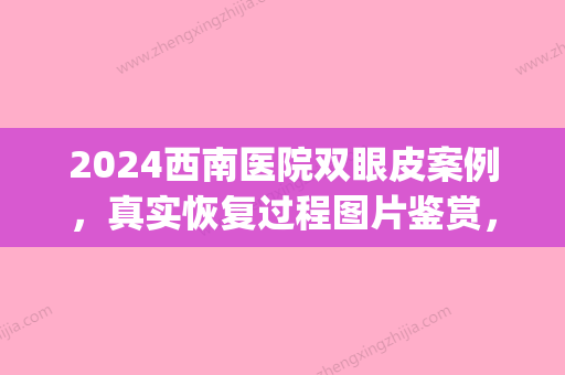 2024西南医院双眼皮案例，真实恢复过程图片鉴赏	，真是超美！(西南医院双眼皮手术多少钱)