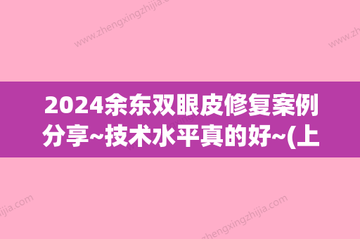 2024余东双眼皮修复案例分享~技术水平真的好~(上海九院余东双眼皮)