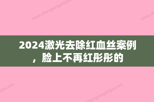 2024激光去除红血丝案例，脸上不再红彤彤的