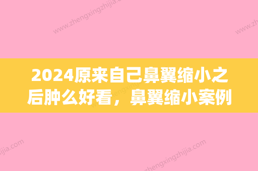 2024原来自己鼻翼缩小之后肿么好看，鼻翼缩小案例~(鼻翼缩小恢复期)