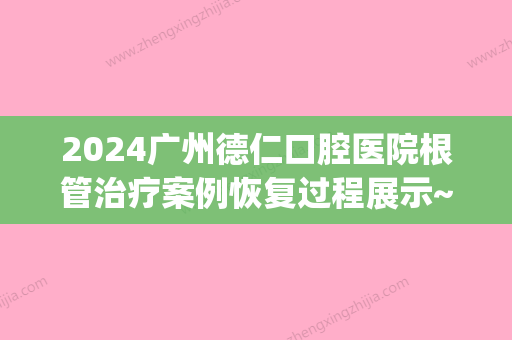 2024广州德仁口腔医院根管治疗案例恢复过程展示~(广东省口腔医院 根管治疗)