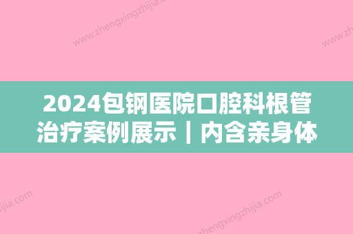 2024包钢医院口腔科根管治疗案例展示｜内含亲身体验感悟