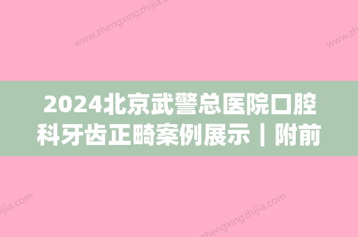 2024北京武警总医院口腔科牙齿正畸案例展示｜附前后体验果图(武警医院矫正牙齿)