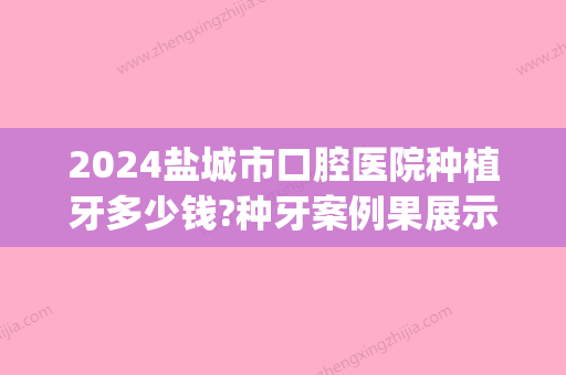 2024盐城市口腔医院种植牙多少钱?种牙案例果展示(盐城种牙多少钱一颗)