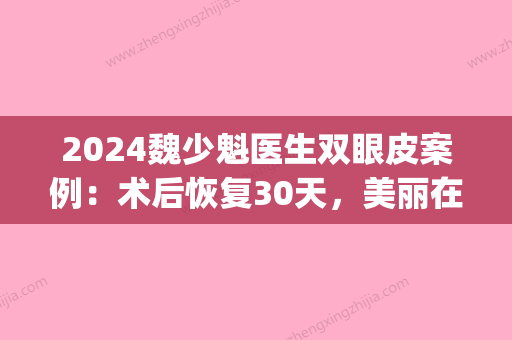 2024魏少魁医生双眼皮案例：术后恢复30天	，美丽在线！(魏少魁医生双眼皮做的好吗)