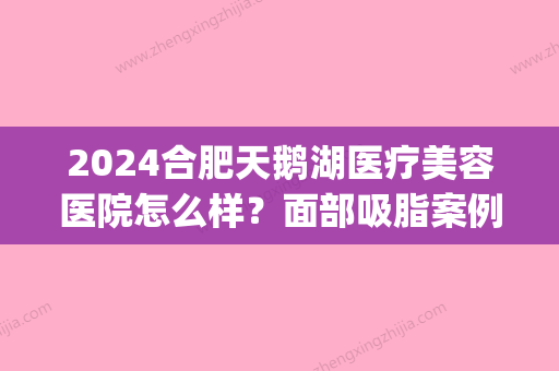 2024合肥天鹅湖医疗美容医院怎么样？面部吸脂案例及果图公布(合肥天鹅湖整形失败)