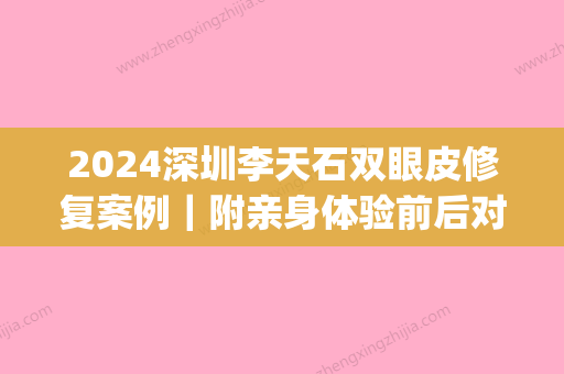 2024深圳李天石双眼皮修复案例｜附亲身体验前后对比图(李天石做双眼皮价格)