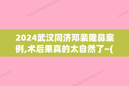 2024武汉同济邓裴隆鼻案例,术后果真的太自然了~(同济邓裴做鼻子好看吗)