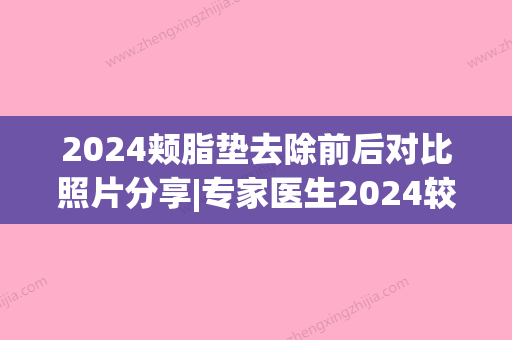 2024颊脂垫去除前后对比照片分享|专家医生2024较新案例展示(去颊脂垫恢复期)