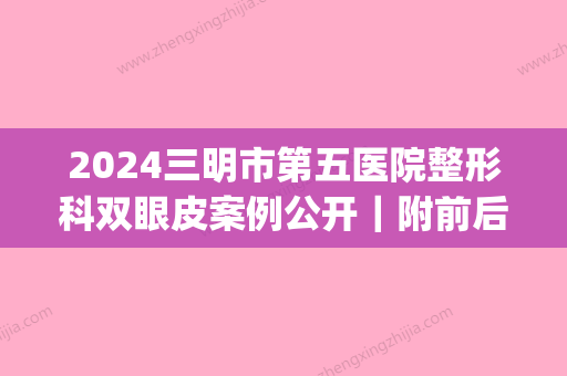 2024三明市第五医院整形科双眼皮案例公开｜附前后对比图(三明第一医院整形外科)