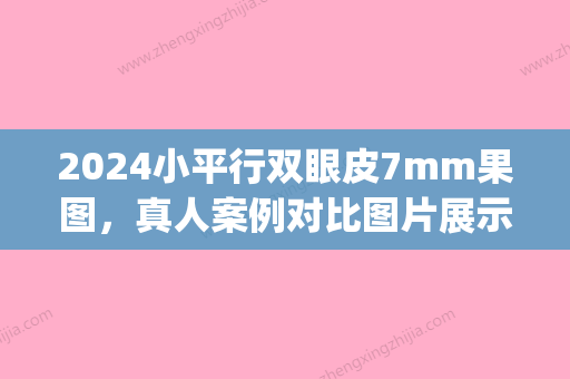 2024小平行双眼皮7mm果图，真人案例对比图片展示(小平行双眼皮效果图 9mm)