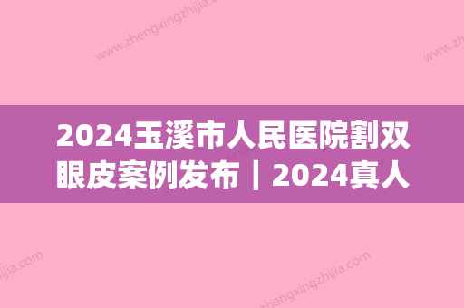 2024玉溪市人民医院割双眼皮案例发布｜2024真人体验过程图分享(玉溪人民医院可以做双眼皮吗)