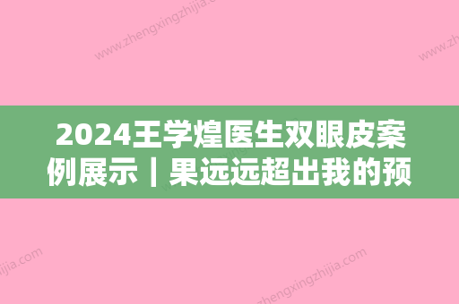 2024王学煌医生双眼皮案例展示｜果远远超出我的预料