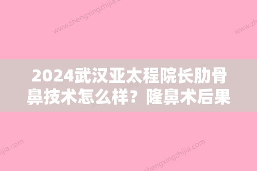 2024武汉亚太程院长肋骨鼻技术怎么样？隆鼻术后果分享