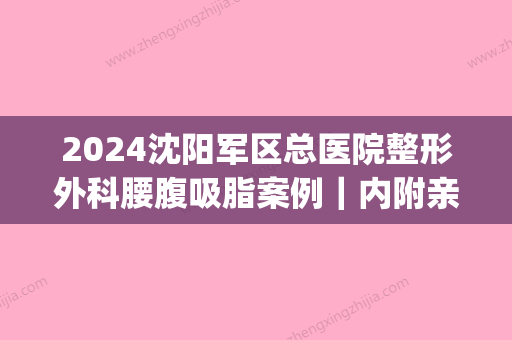 2024沈阳军区总医院整形外科腰腹吸脂案例｜内附亲身体验感悟(沈阳医大一院吸脂手术)