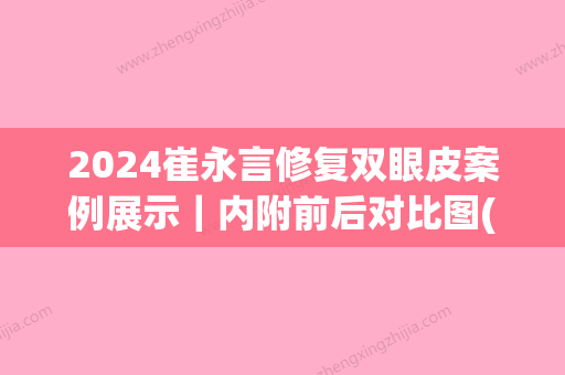 2024崔永言修复双眼皮案例展示｜内附前后对比图(双眼皮恢复期对比图)