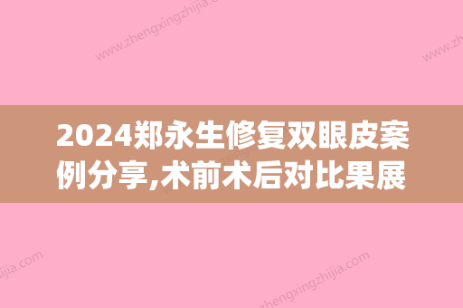 2024郑永生修复双眼皮案例分享,术前术后对比果展示(白永辉修复双眼皮案例)