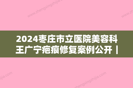 2024枣庄市立医院美容科王广宁疤痕修复案例公开｜内附前后对比图