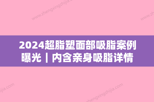 2024超脂塑面部吸脂案例曝光｜内含亲身吸脂详情