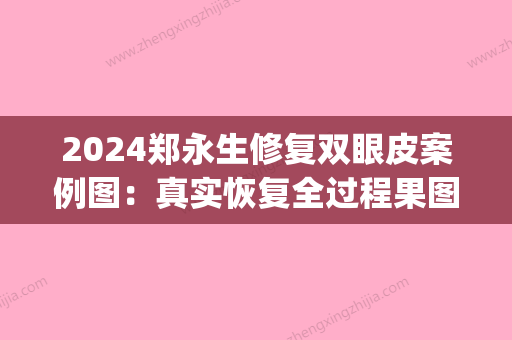 2024郑永生修复双眼皮案例图：真实恢复全过程果图片展示(王永久做双眼皮修复如何)