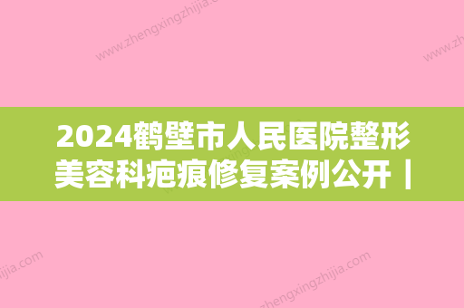 2024鹤壁市人民医院整形美容科疤痕修复案例公开｜附体验果图