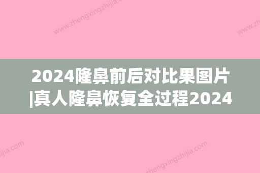 2024隆鼻前后对比果图片|真人隆鼻恢复全过程2024(隆鼻恢复期鼻头变化图)