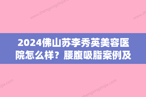 2024佛山苏李秀英美容医院怎么样？腰腹吸脂案例及对比图分享(佛山苏李秀英整形医院地址)