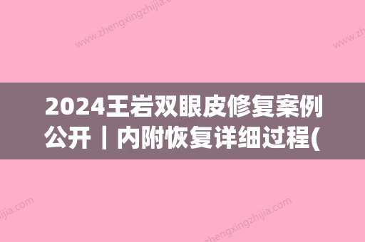 2024王岩双眼皮修复案例公开｜内附恢复详细过程(王振军双眼皮修复案例)