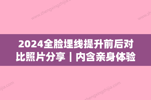 2024全脸埋线提升前后对比照片分享｜内含亲身体验感悟(全脸埋线提升的过程图片)