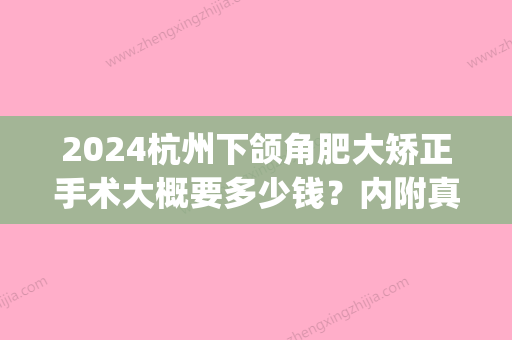 2024杭州下颌角肥大矫正手术大概要多少钱？内附真人案例分享(上海下颌角矫形多少钱)