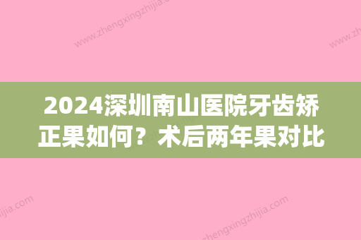 2024深圳南山医院牙齿矫正果如何？术后两年果对比！(深圳牙科正畸)