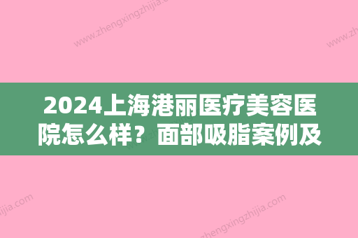 2024上海港丽医疗美容医院怎么样？面部吸脂案例及感悟展示