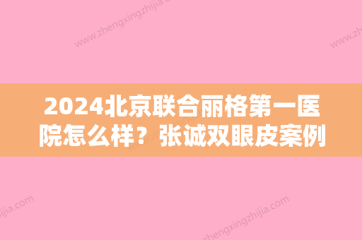 2024北京联合丽格第一医院怎么样？张诚双眼皮案例公开