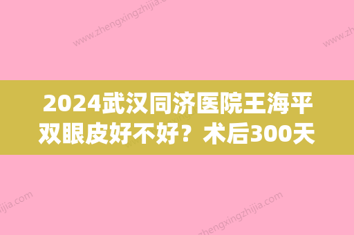 2024武汉同济医院王海平双眼皮好不好？术后300天案例分享~(武汉同济医院割双眼皮哪个医生好)