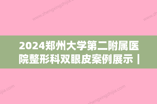 2024郑州大学第二附属医院整形科双眼皮案例展示｜附恢复前后果图(郑州大学第二附属医院割双眼皮)