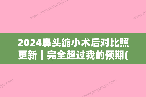 2024鼻头缩小术后对比照更新｜完全超过我的预期(缩小鼻头3个月还是很大)