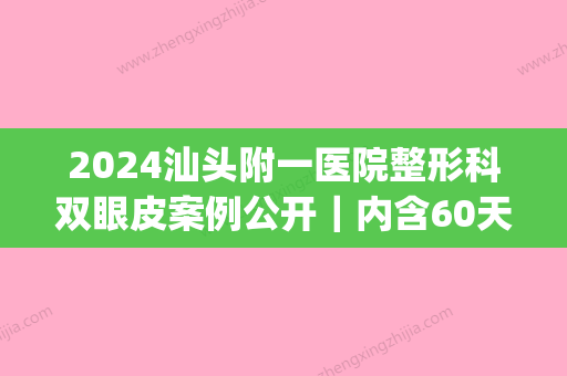 2024汕头附一医院整形科双眼皮案例公开｜内含60天变化果图(汕头附一医院整形好么)