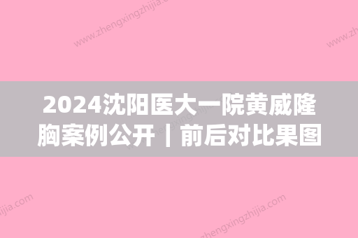 2024沈阳医大一院黄威隆胸案例公开｜前后对比果图让人爱了(沈阳医大一院黄威隆鼻怎么样)