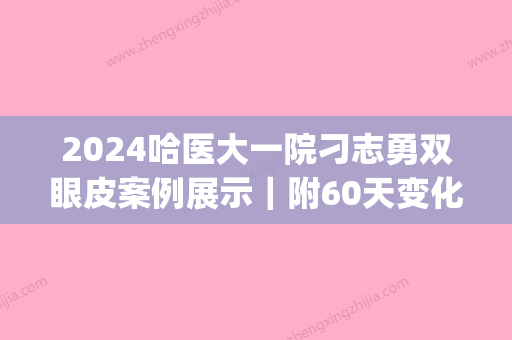 2024哈医大一院刁志勇双眼皮案例展示｜附60天变化果图(哈尔滨刁志勇双眼皮)