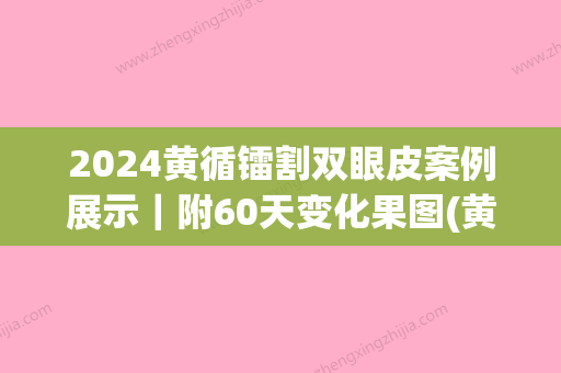 2024黄循镭割双眼皮案例展示｜附60天变化果图(黄循镭做的双眼皮)