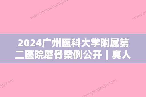 2024广州医科大学附属第二医院磨骨案例公开｜真人体验全过程展示