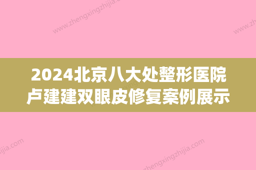 2024北京八大处整形医院卢建建双眼皮修复案例展示｜附体验果图(卢建建双眼皮做得怎么样)