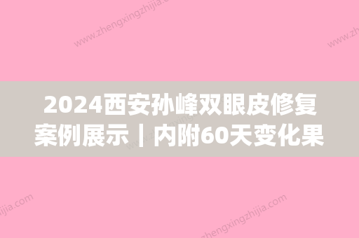 2024西安孙峰双眼皮修复案例展示｜内附60天变化果图(西安孙峰双眼皮手术好不好?)