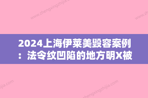 2024上海伊莱美毁容案例：法令纹凹陷的地方明X被填平