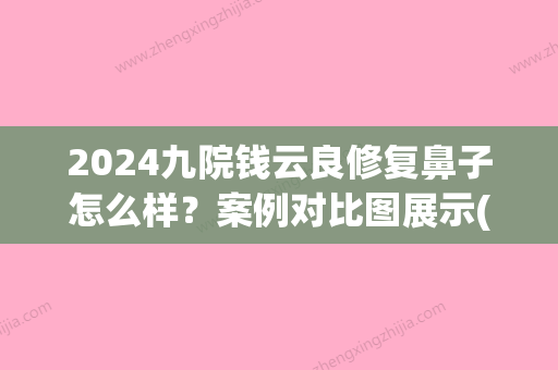 2024九院钱云良修复鼻子怎么样？案例对比图展示(九院钱云良做鼻子怎么样)