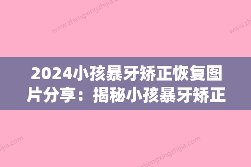 2024小孩暴牙矫正恢复图片分享：揭秘小孩暴牙矫正全过程~(孩子暴牙用矫正吗)