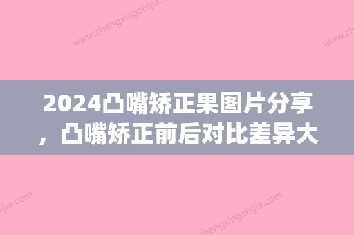 2024凸嘴矫正果图片分享，凸嘴矫正前后对比差异大~(凸嘴什么时候矫正比较好)